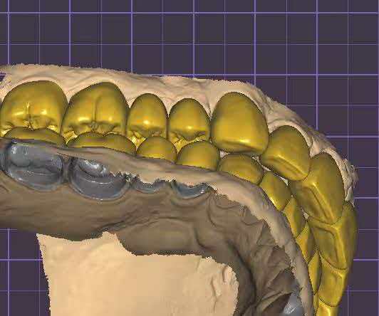 Upper and lower Smile Design