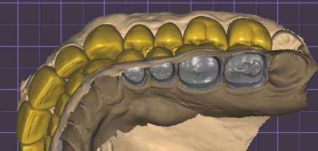 Upper and lower Smile Design