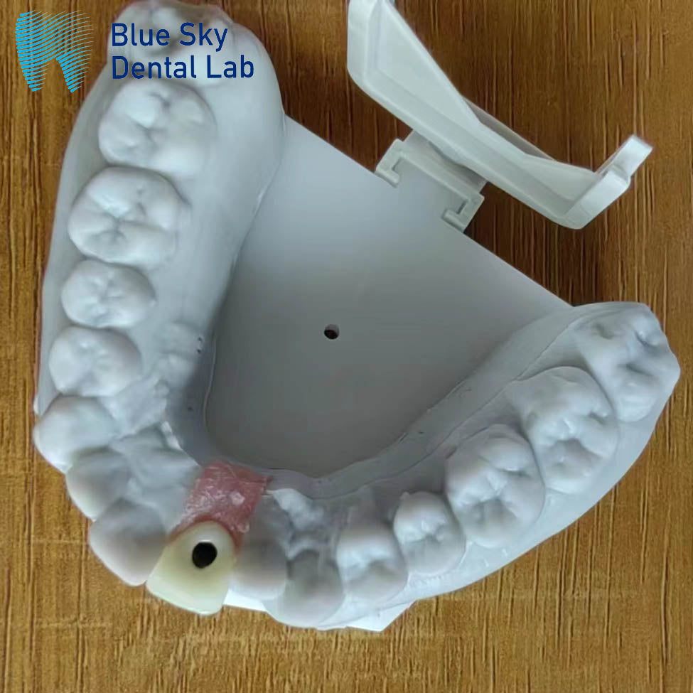 Zirconia Implant Crown Screw Retained Zirconia Dental Crown