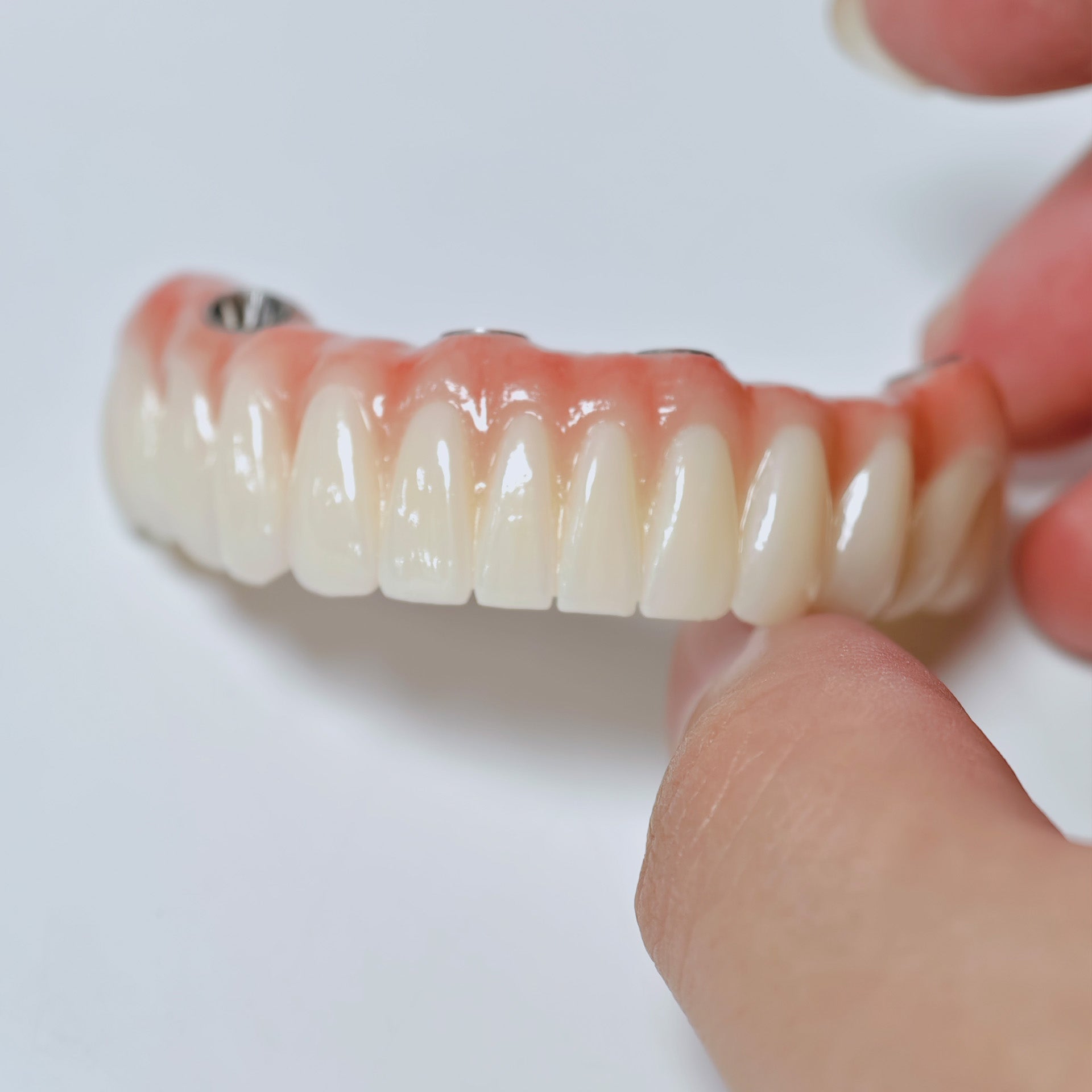 All On 4 Zirconia Bridge With Ti-Base Screw Retained