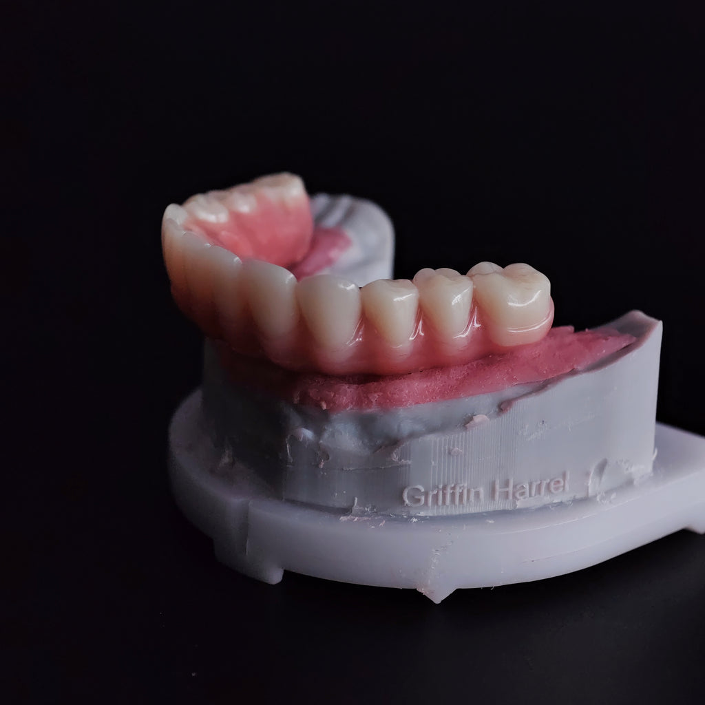 An Acrylic Denture With A Titanium Bar (Ti-Bar) Cost-Effective Full Arch Restoration Screw Retained