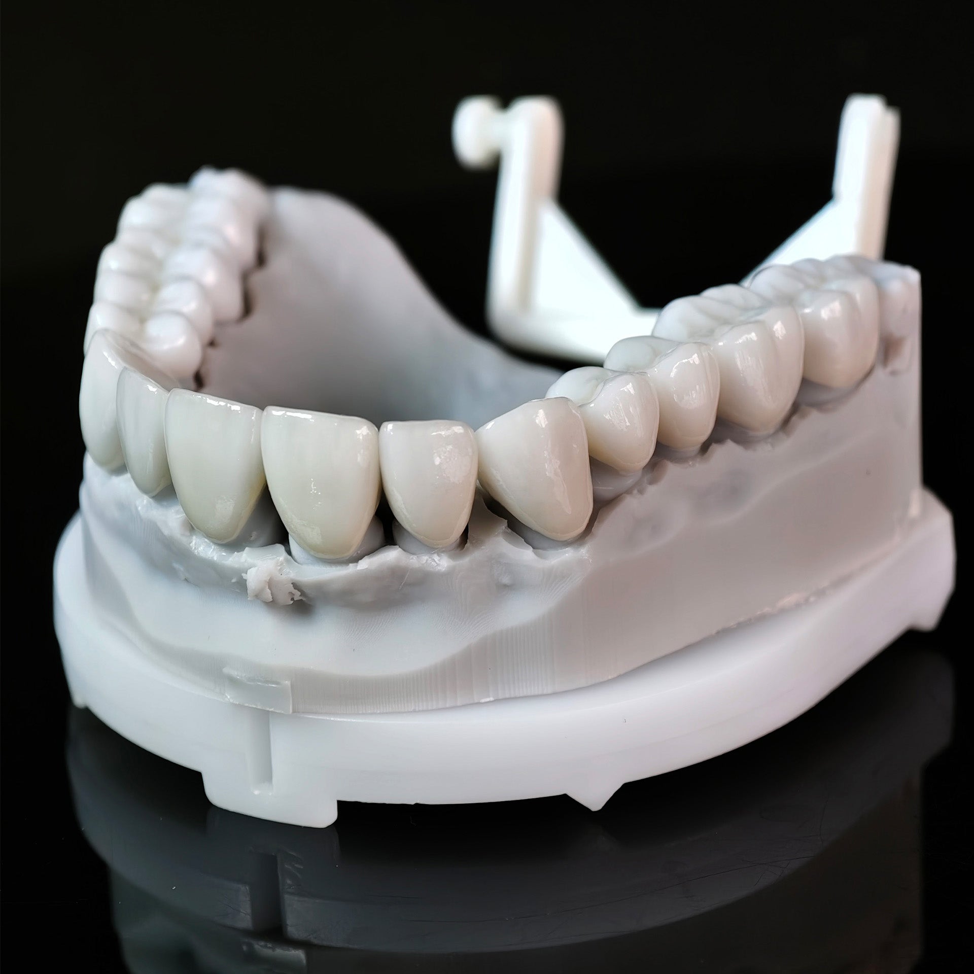 Ceramic Veneers And Crown With Cement Retained