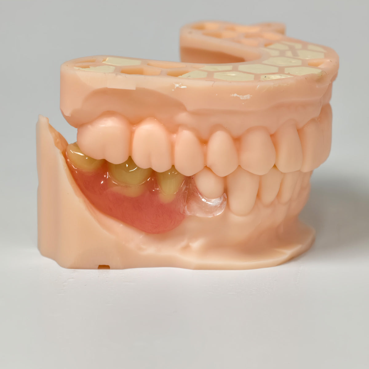 Clear Framework With Acrylic Denture Aesthetic Denture