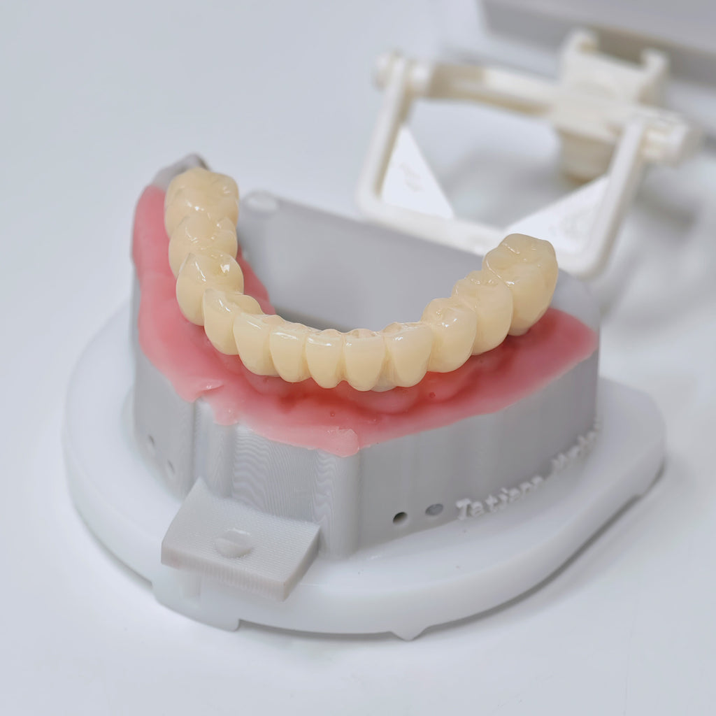 Custom Abutment And PMMA Bridge With Cement Retained And Implant Seating Guide