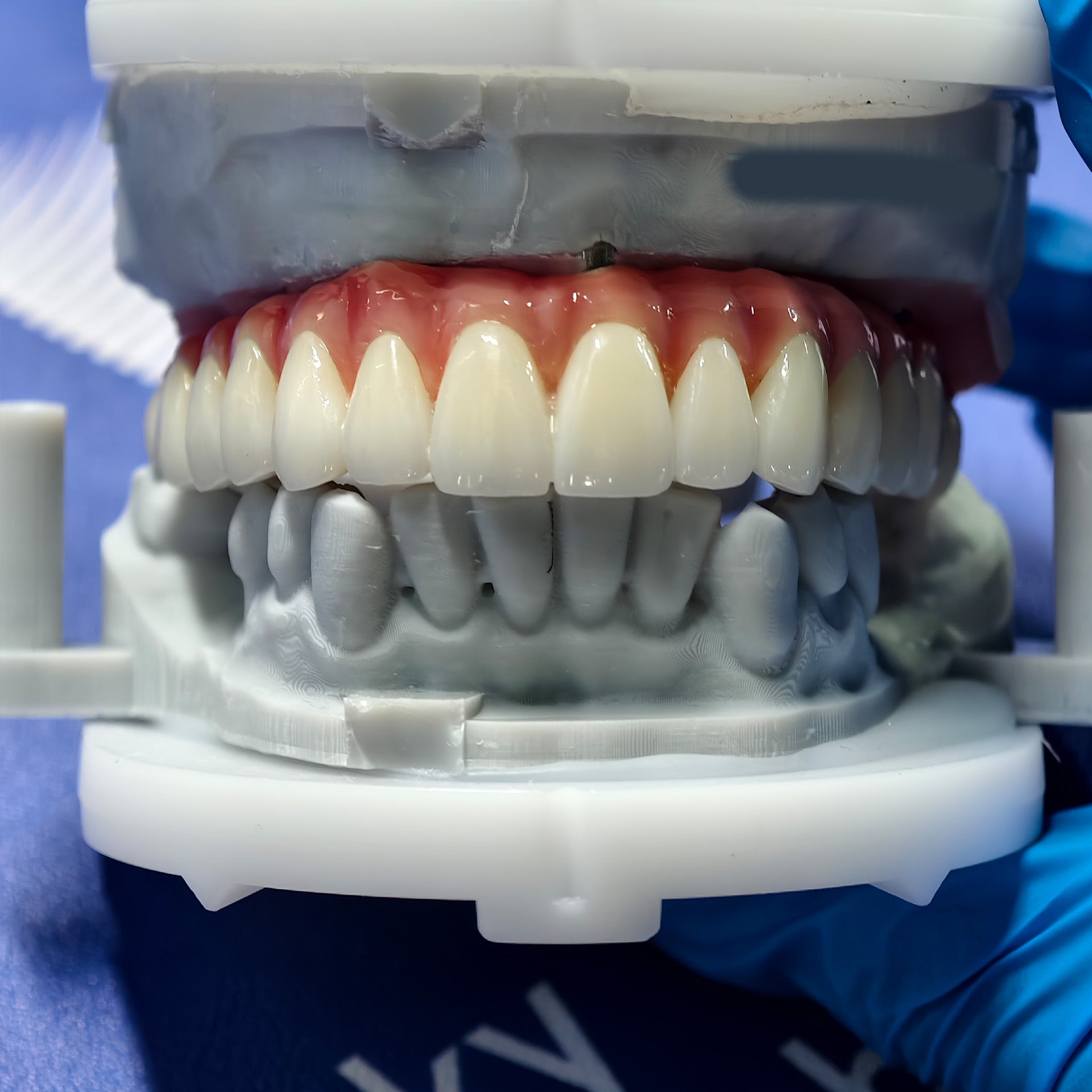 Enhanced Zirconia Crown Malo Bridge