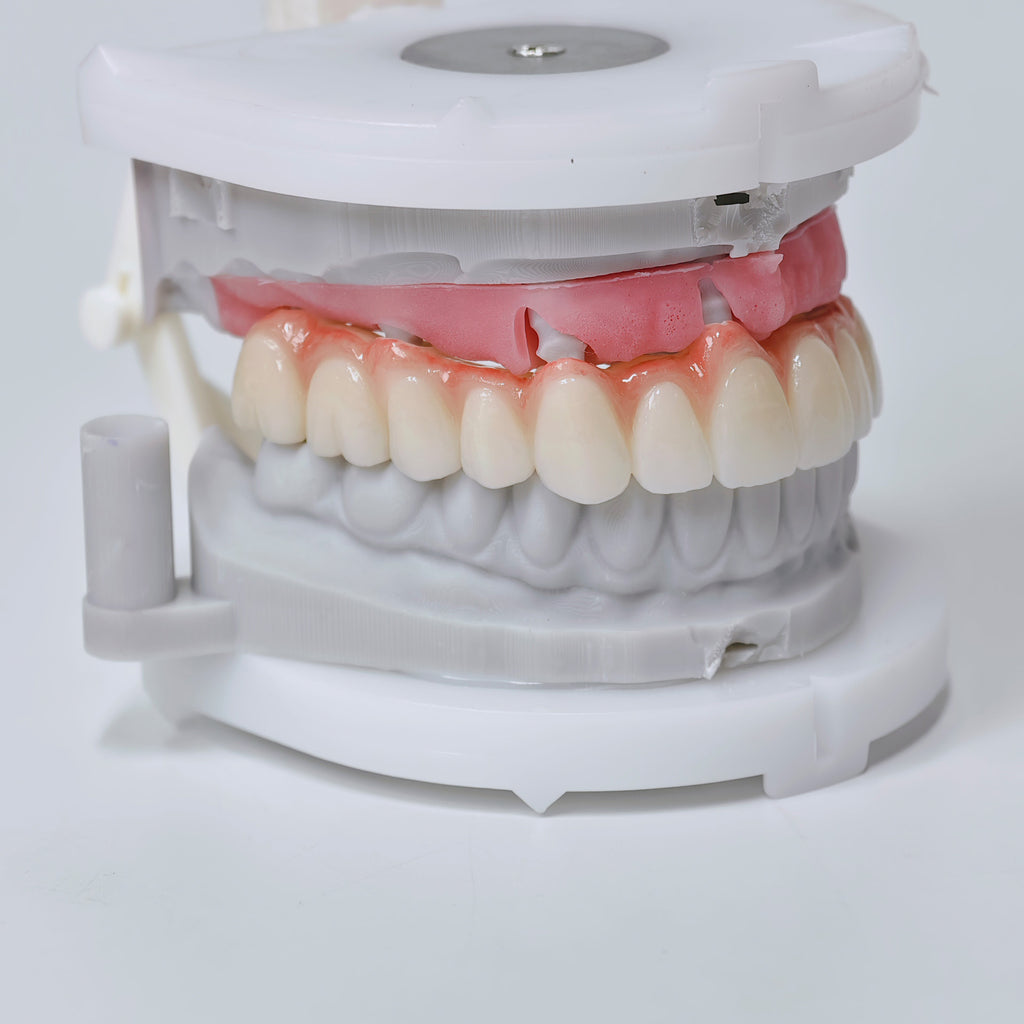 Half-Mouth Zirconia Bridge With Cement-Retained