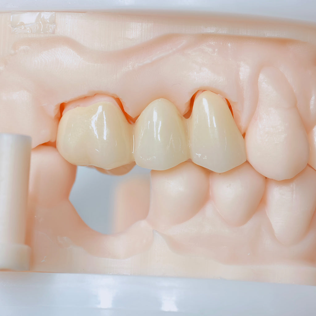 High - Strength Zirconia Bridge