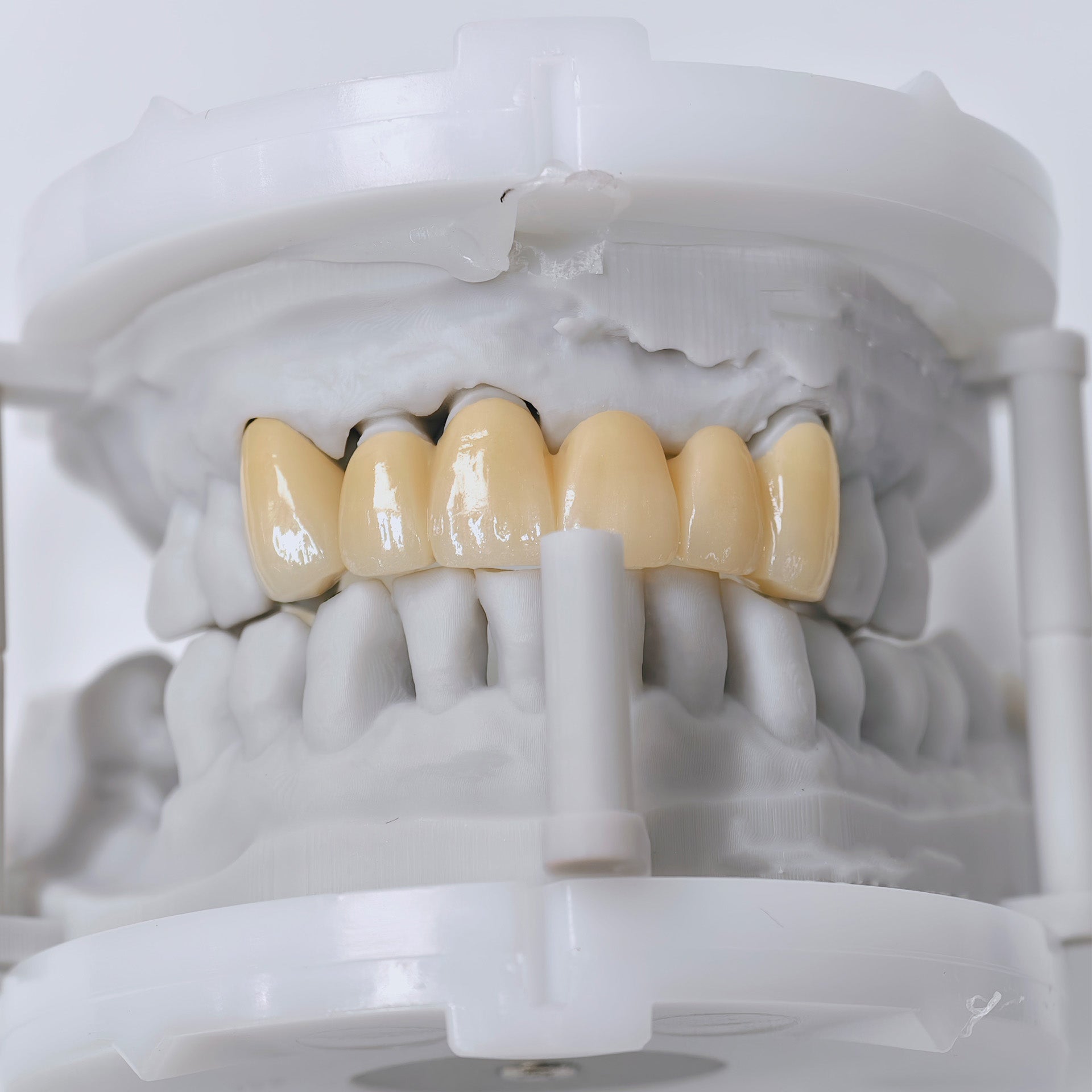High - Strength Zirconia Crown And Bridge