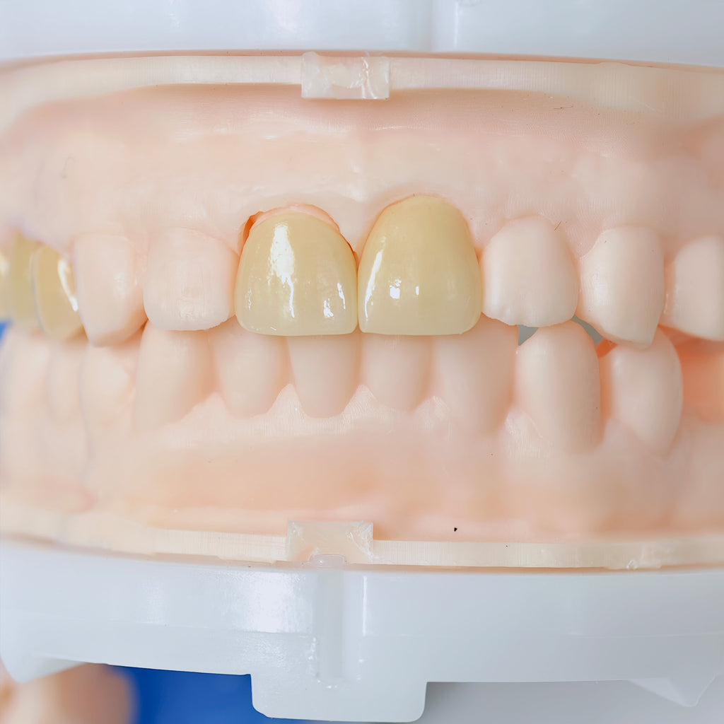 High - Strength Zirconia Crowns