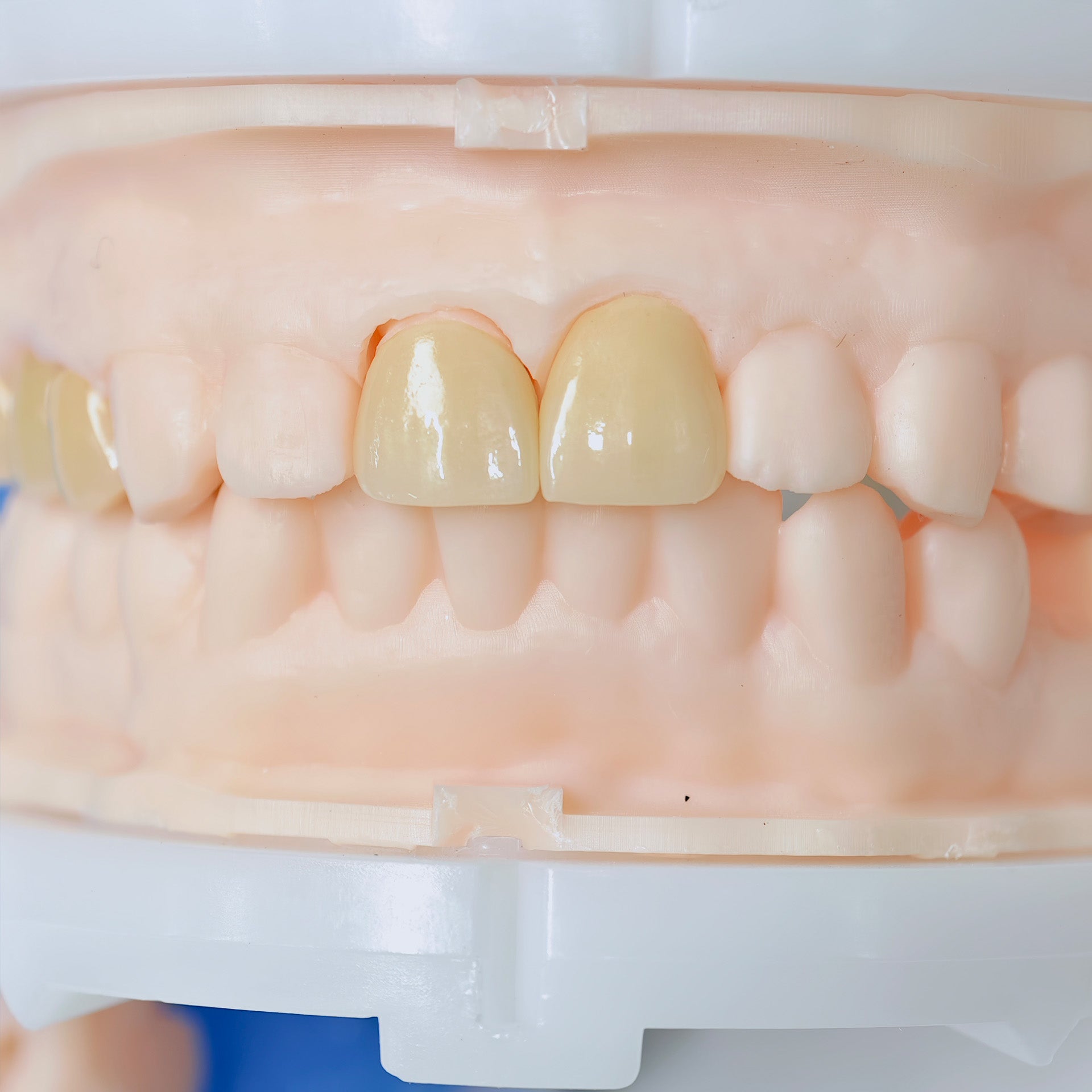 High - Strength Zirconia Crowns