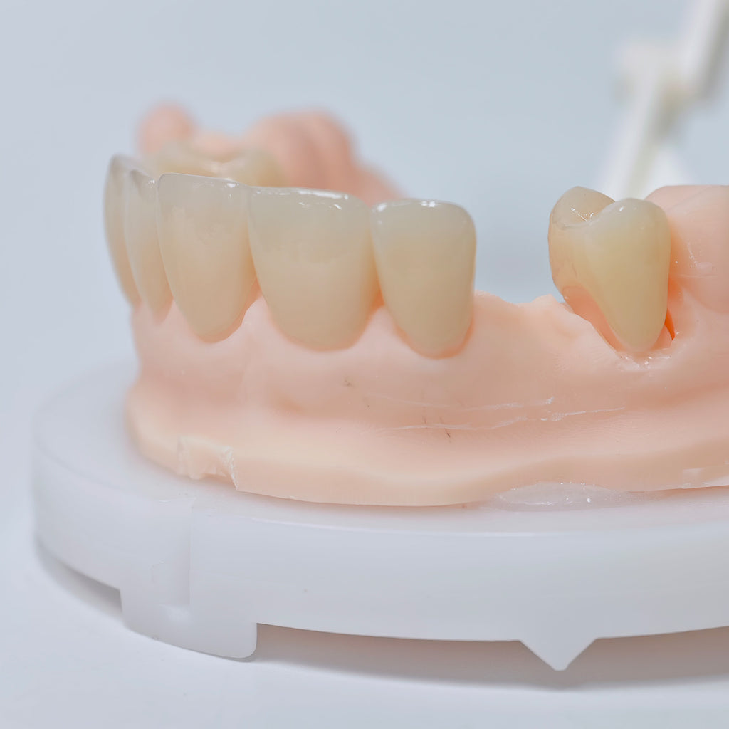 High - Strength Zirconia Crowns And Ceramic Veneers