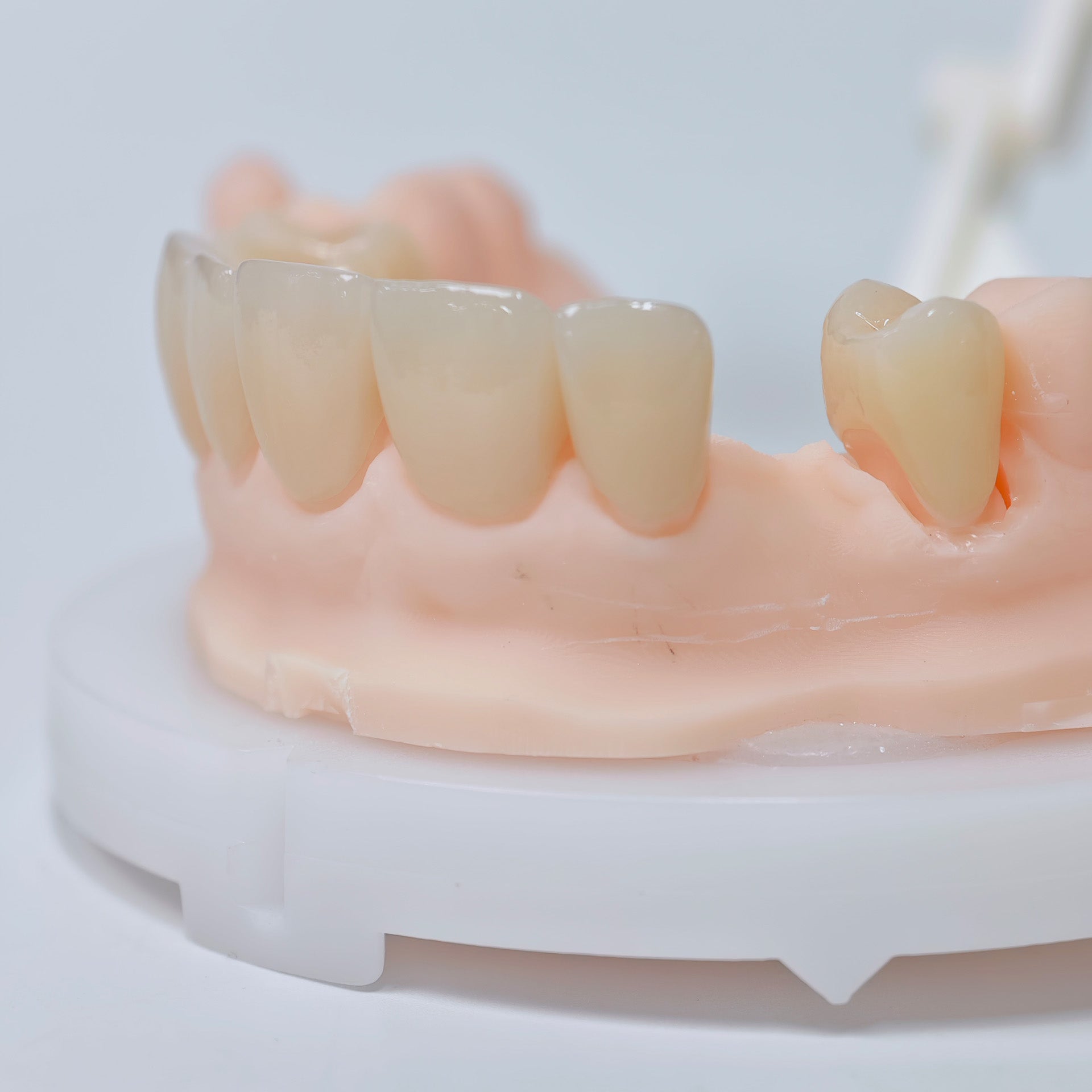 High - Strength Zirconia Crowns And Ceramic Veneers