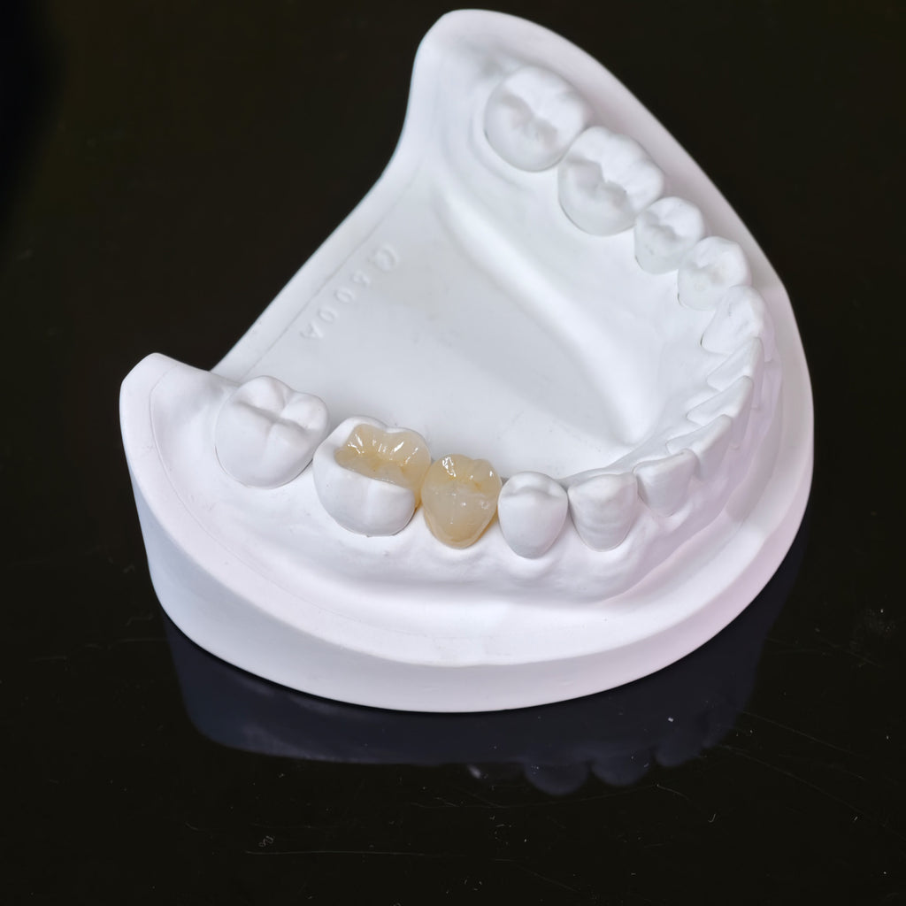 High - Strength Zirconia Inlay And Crown