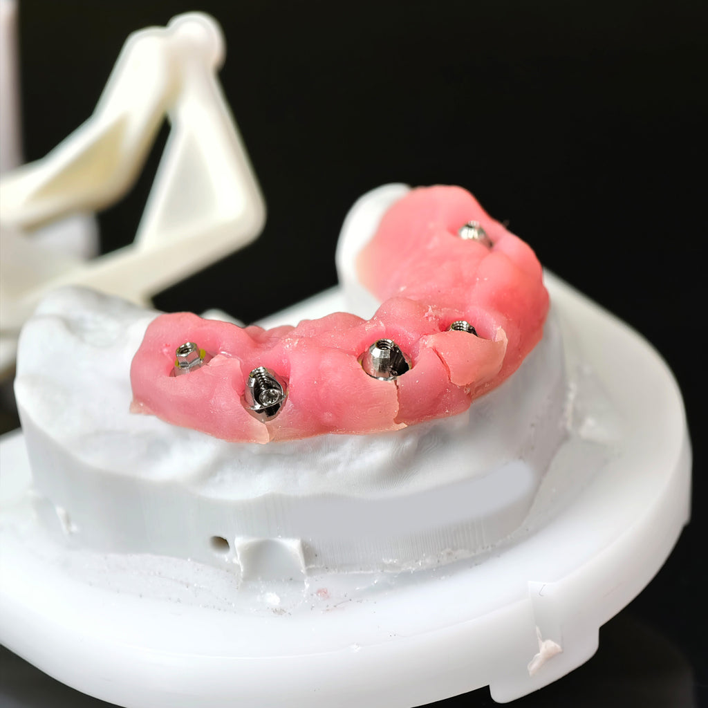 Implant-supported Co - Cr PFM Dental Bridge