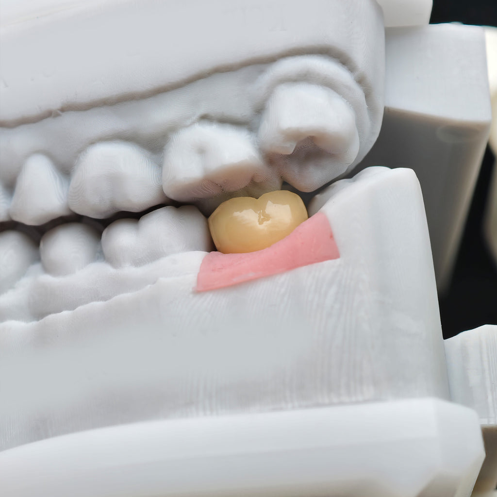Implant-Supported PFM Single Crown With Metal