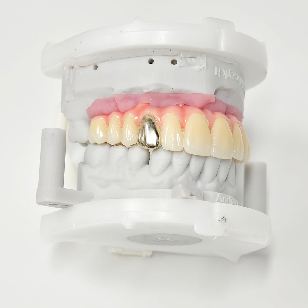 Malo Bridge With Gold-Plated Titanium Framework And A Gold Crown
