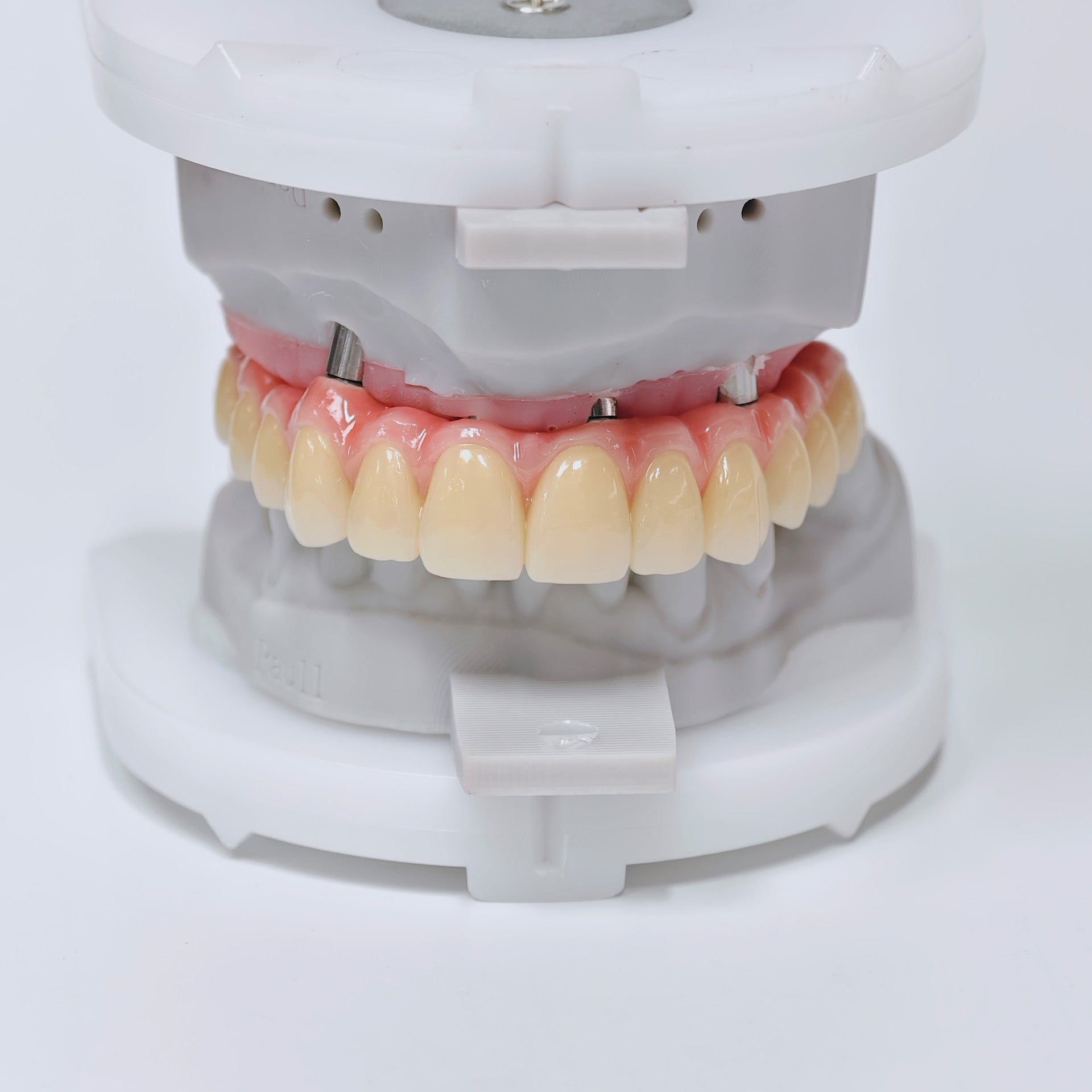 Malo Bridge With Screw-Retained