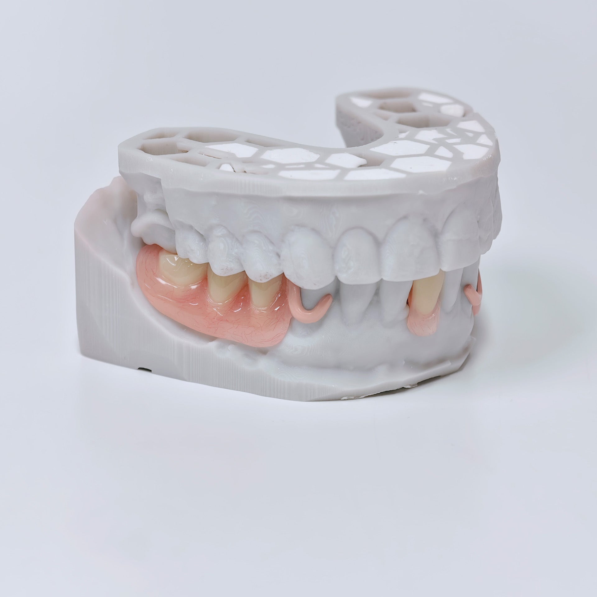 PEEK Framework Denture Metal Framework With Acrylic Denture