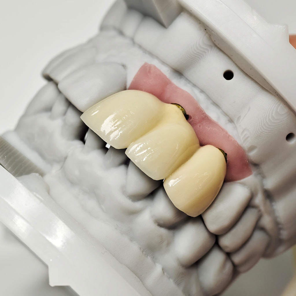 PFM Bridge With Screw-Retained And Implant Seating Guide