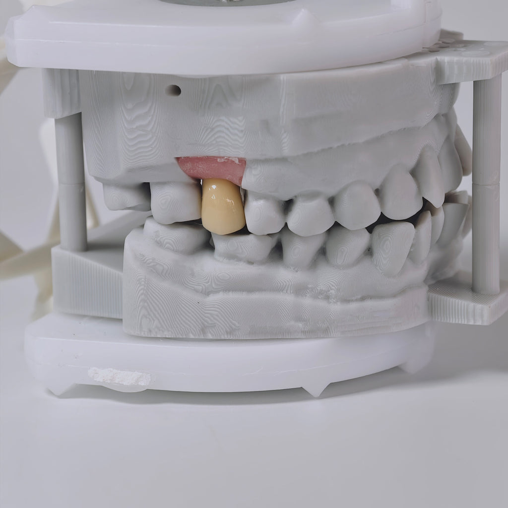 PFM Crown With Screw Retained