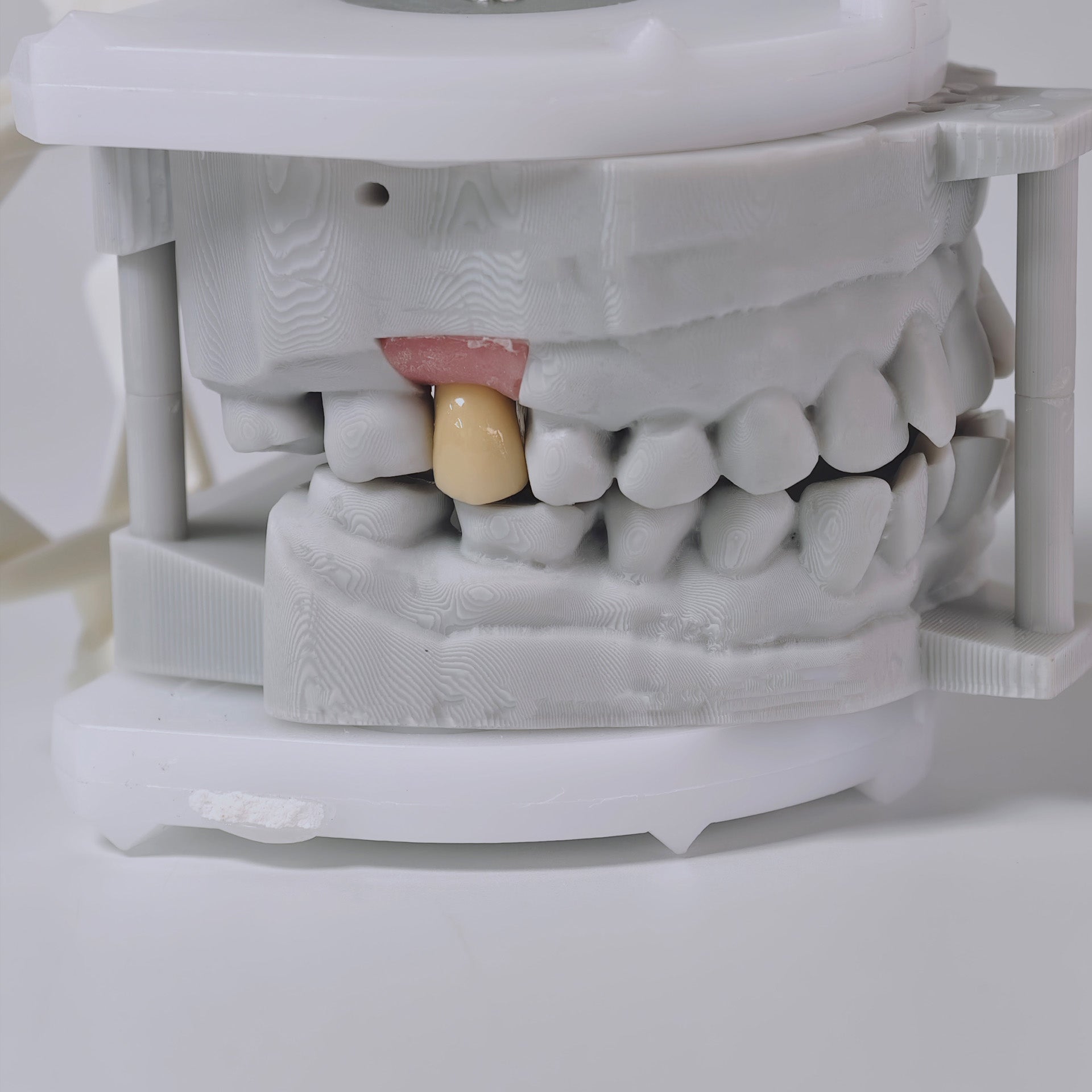 PFM Crown With Screw Retained