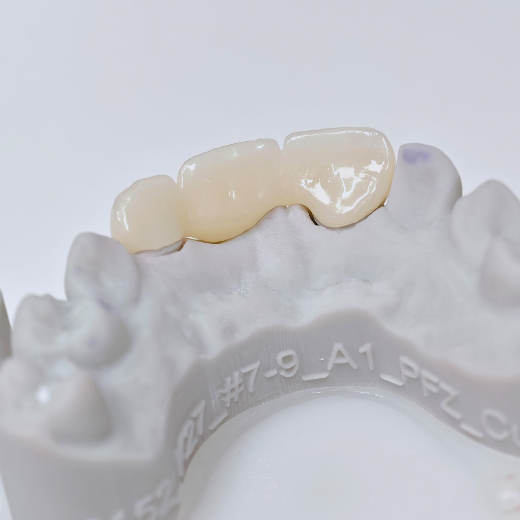 PFZ Dental Bridge – Depth And Aesthetics