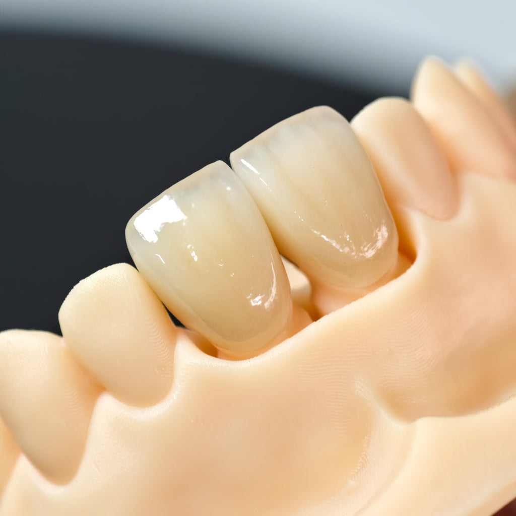 PFZ Crowns Aesthetic Shape Natural Shade Dental Crown