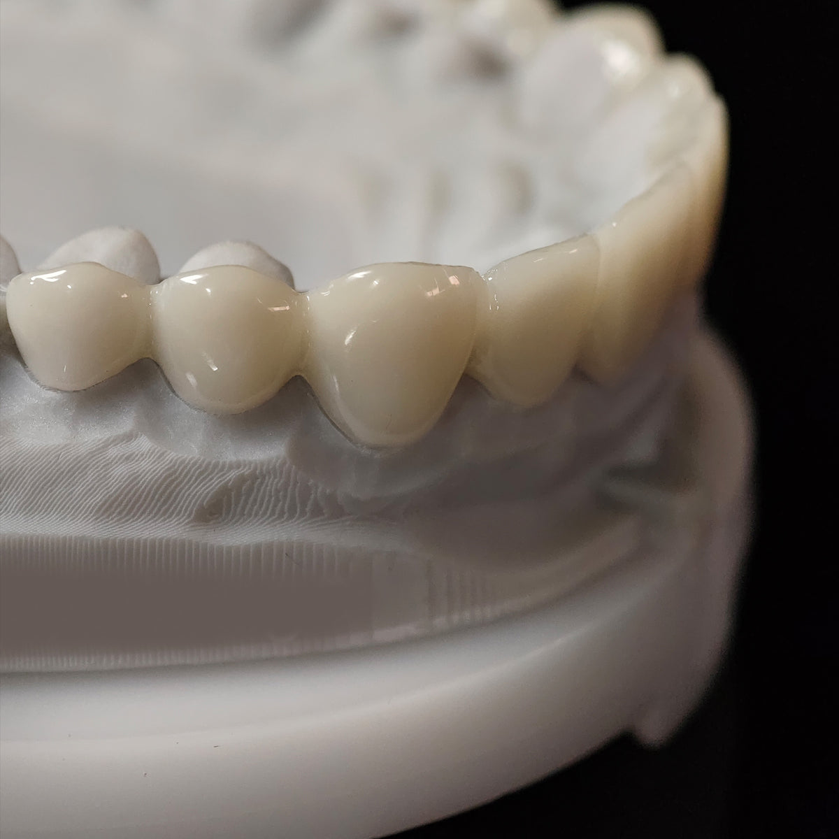 PMMA Bridge Veneer With Cement Retained