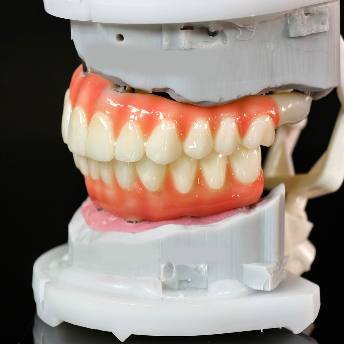 PMMA Bridge With Ti-Base Screw Retained Trying For Full Arch Restoration