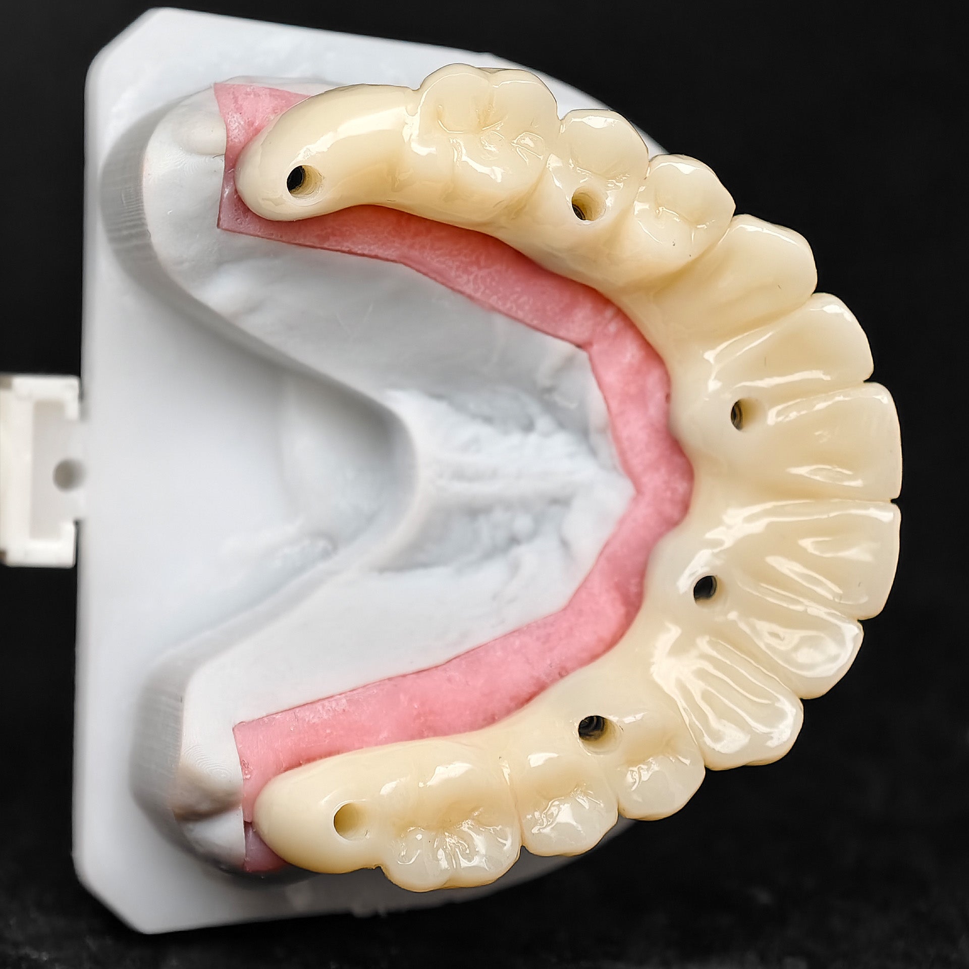 PMMA Bridge With Ti-Base Screw Retained Trying For Full Arch Restoration
