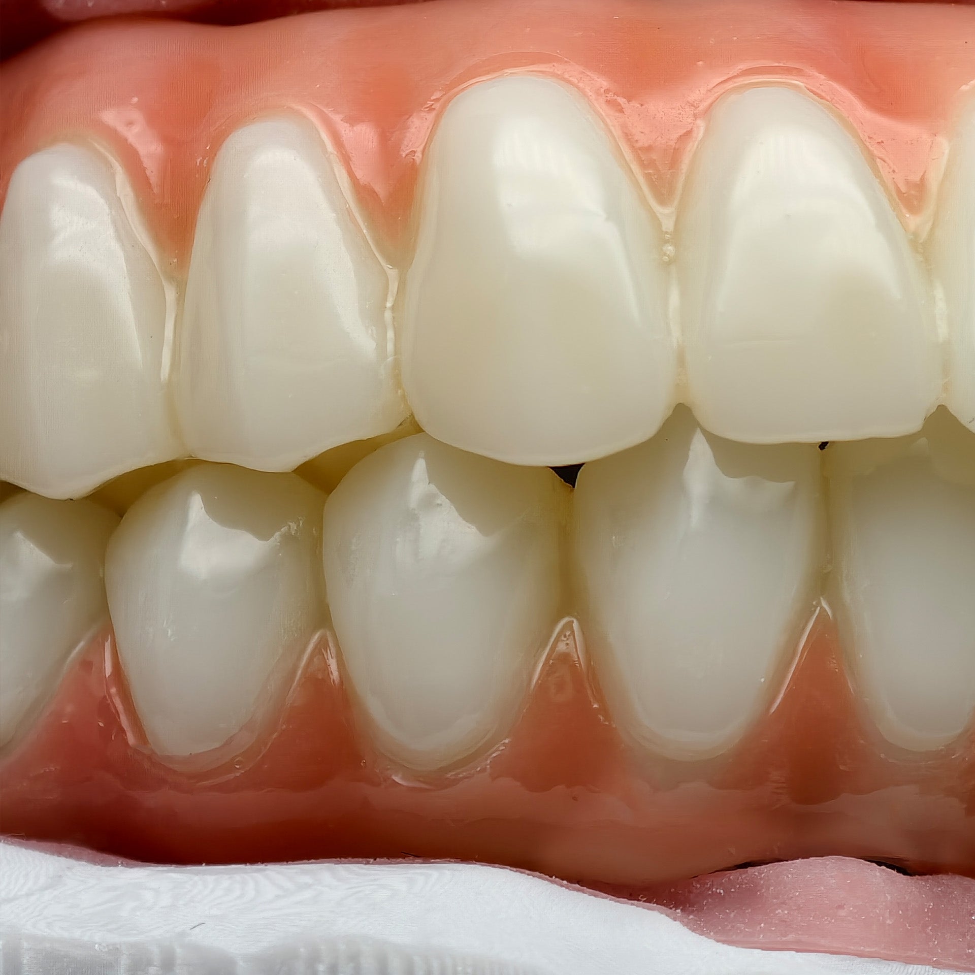 PMMA Bridge With Ti-Base Screw Retained Trying For Full Arch Restoration