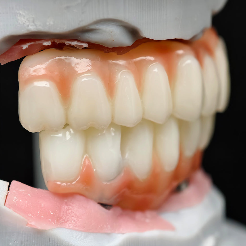 PMMA Bridge With Ti-Base Screw Retained Trying For Full Arch Restoration