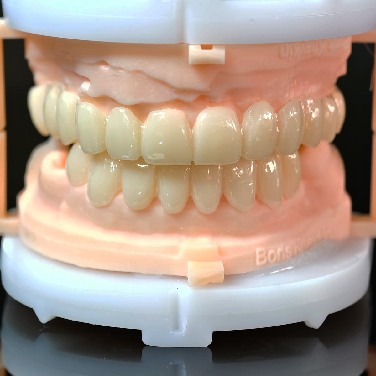 PMMA Bridge With Open Shell Preparing For Full Arch Dental Implants