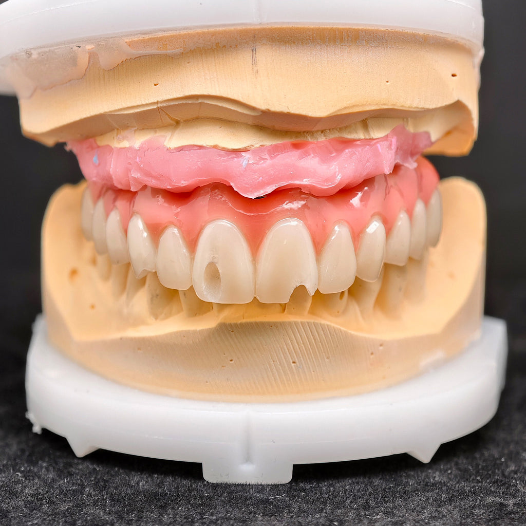 Pmma Bridge With Screw-Retained