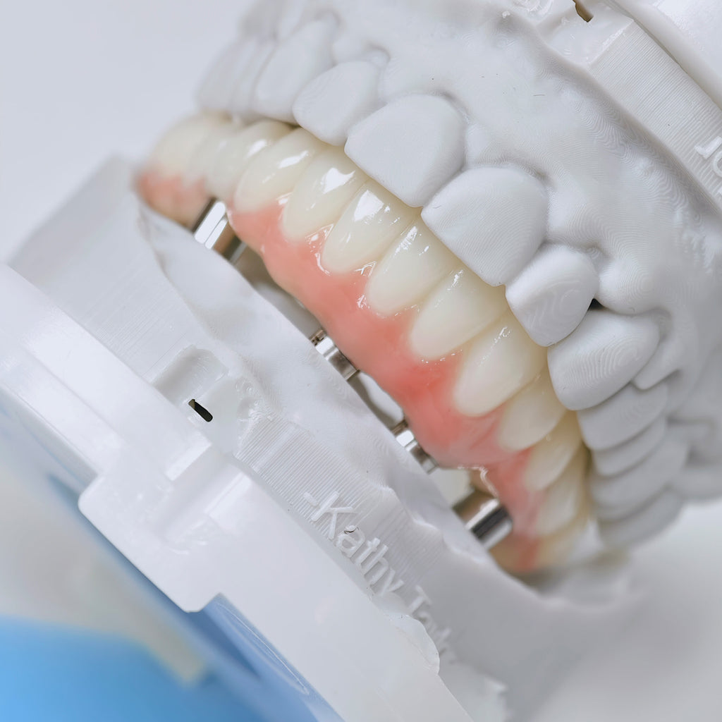 PMMA Bridge With Screw Retained