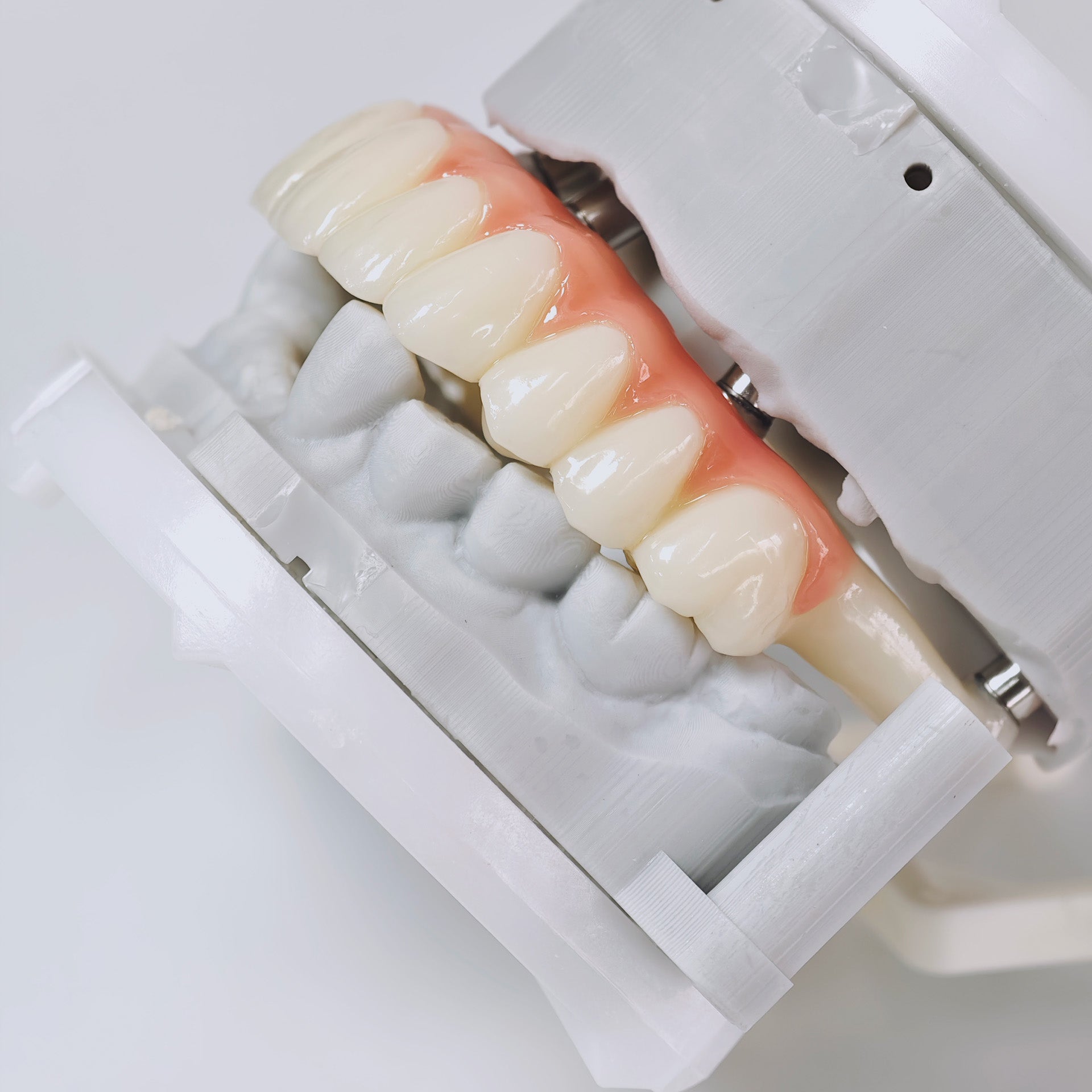PMMA Bridge With Screw Retained