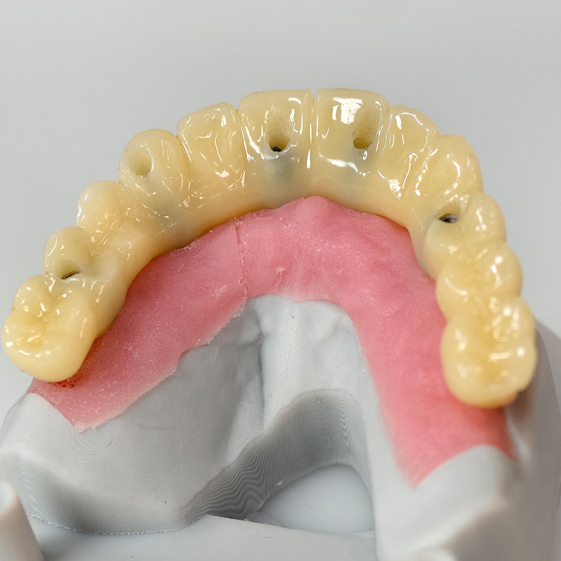 PMMA Bridge With Screw Retained