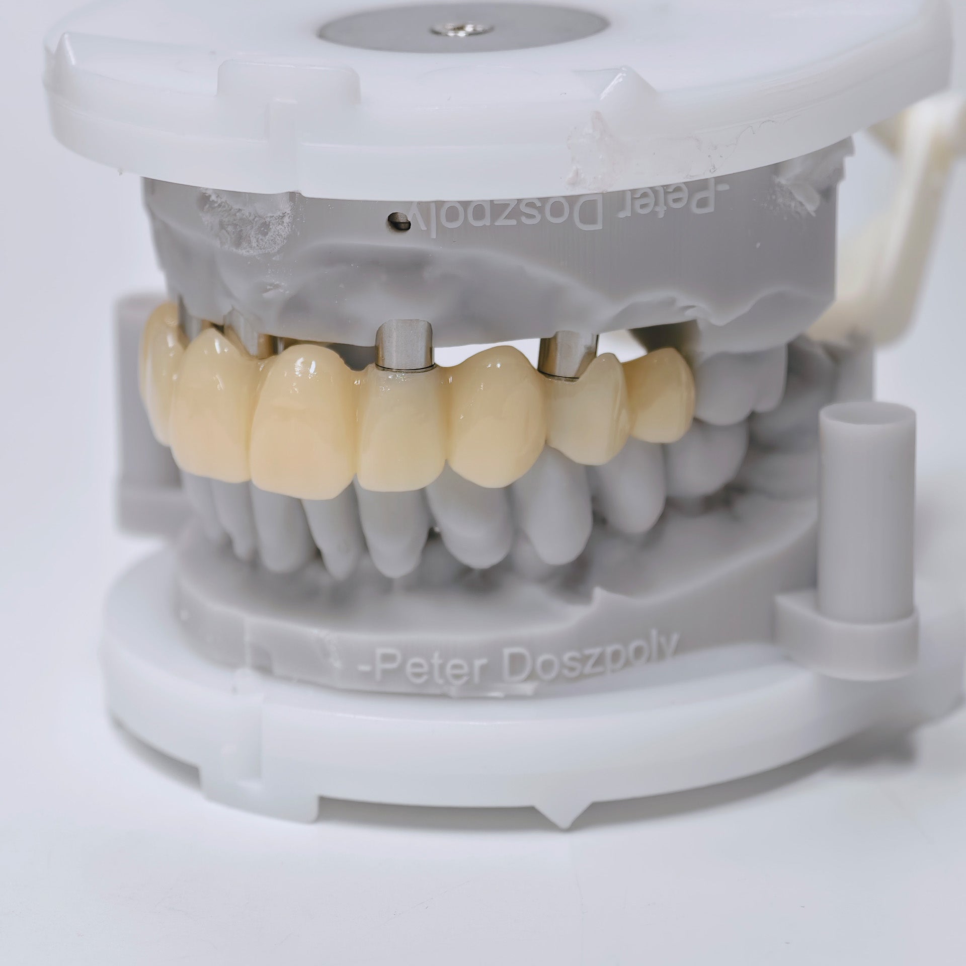 PMMA Bridge With Screw Retained