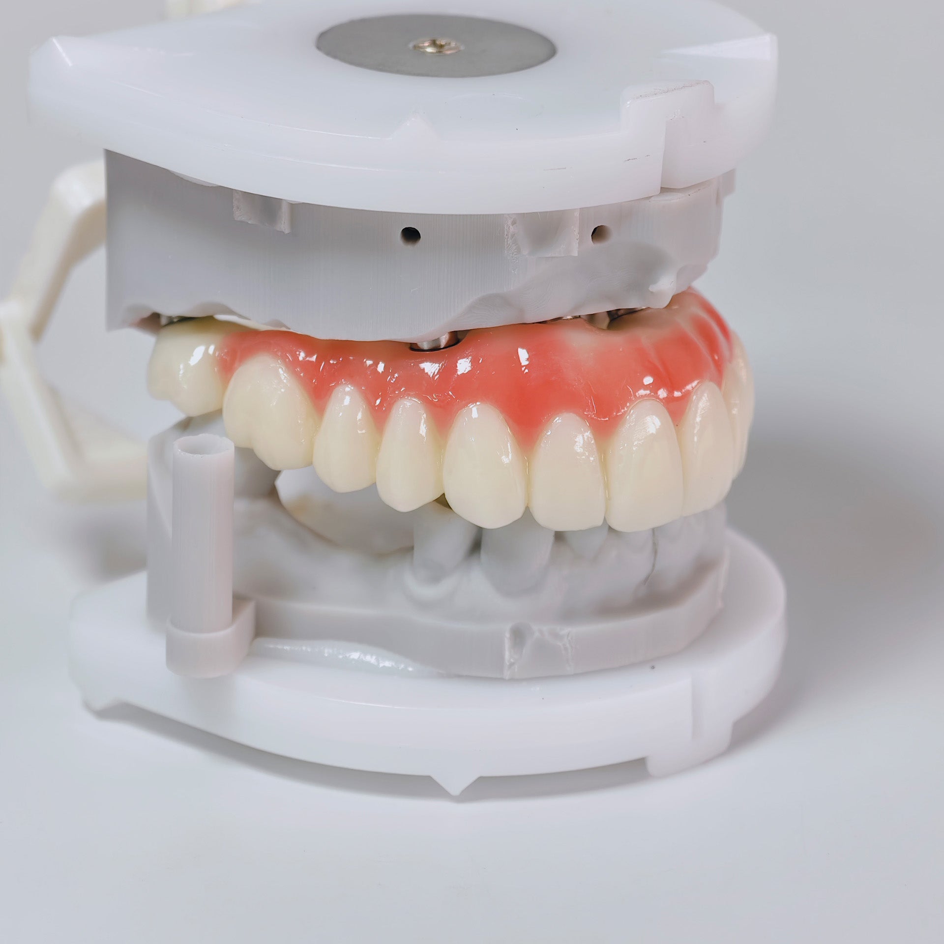 PMMA Bridge With Screw Retained