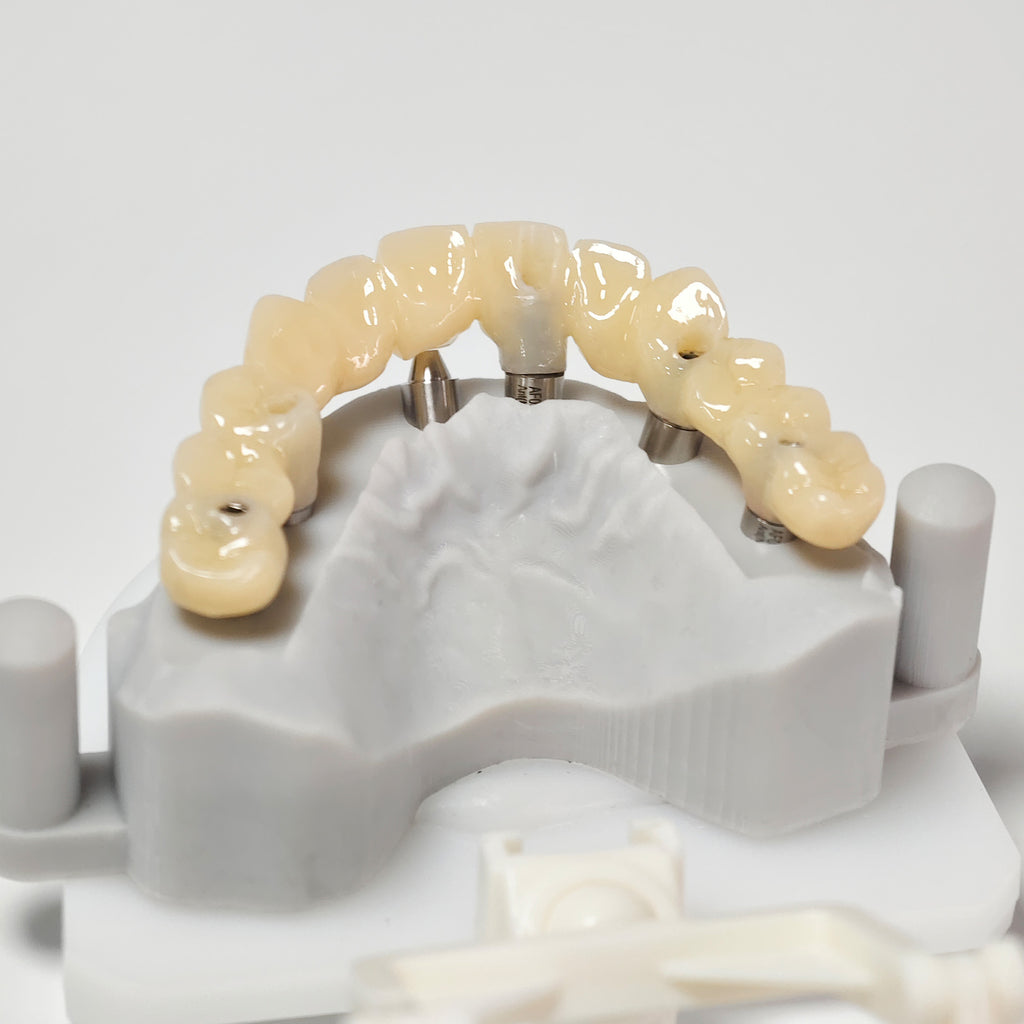 PMMA Bridge With Screw Retained