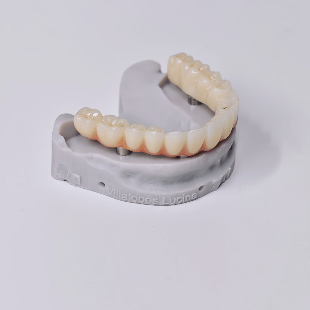 Ti-Bar Titanium Gold-Plated Metal Frame With Zirconia Bridge And Screw Retained