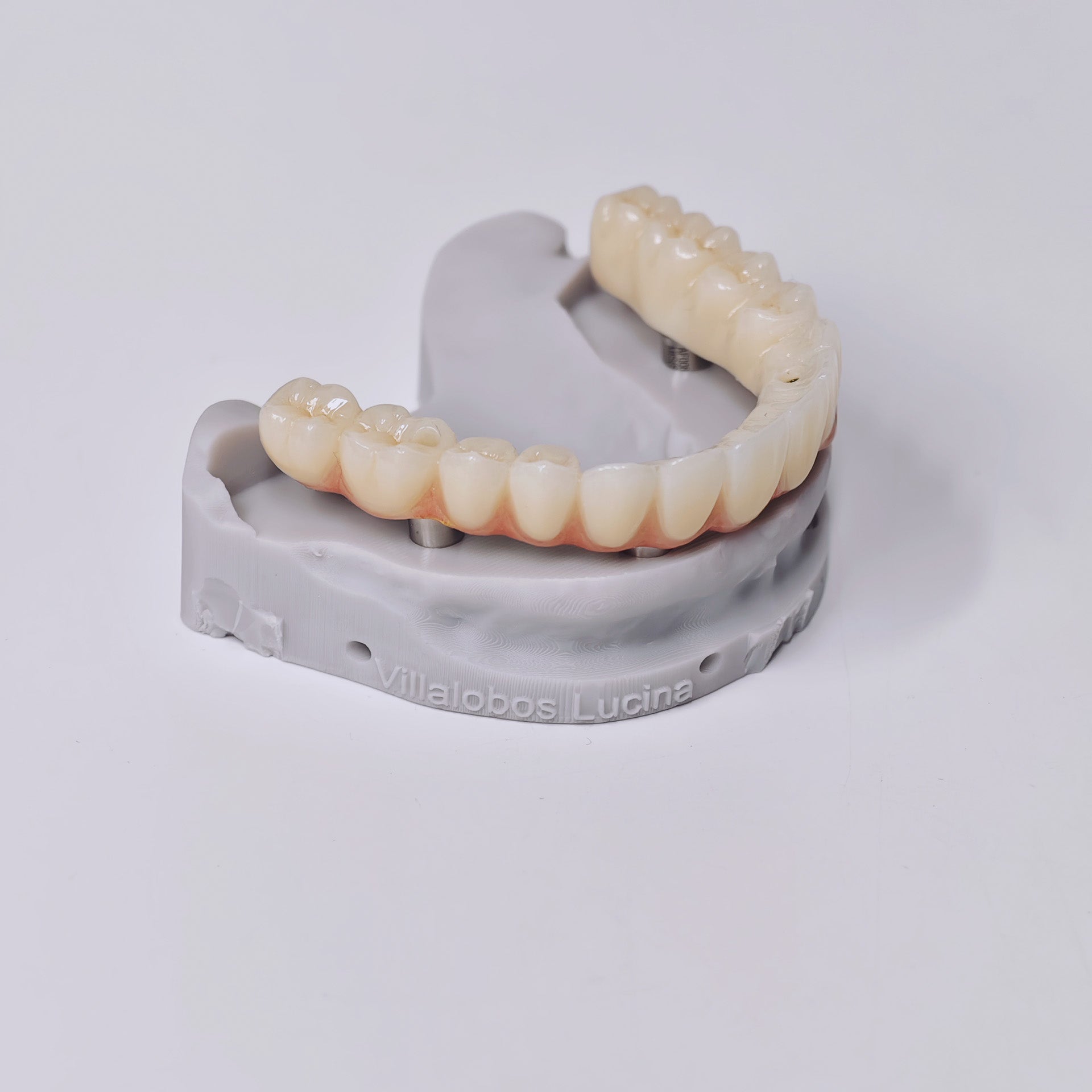 Ti-Bar Titanium Gold-Plated Metal Frame With Zirconia Bridge And Screw Retained