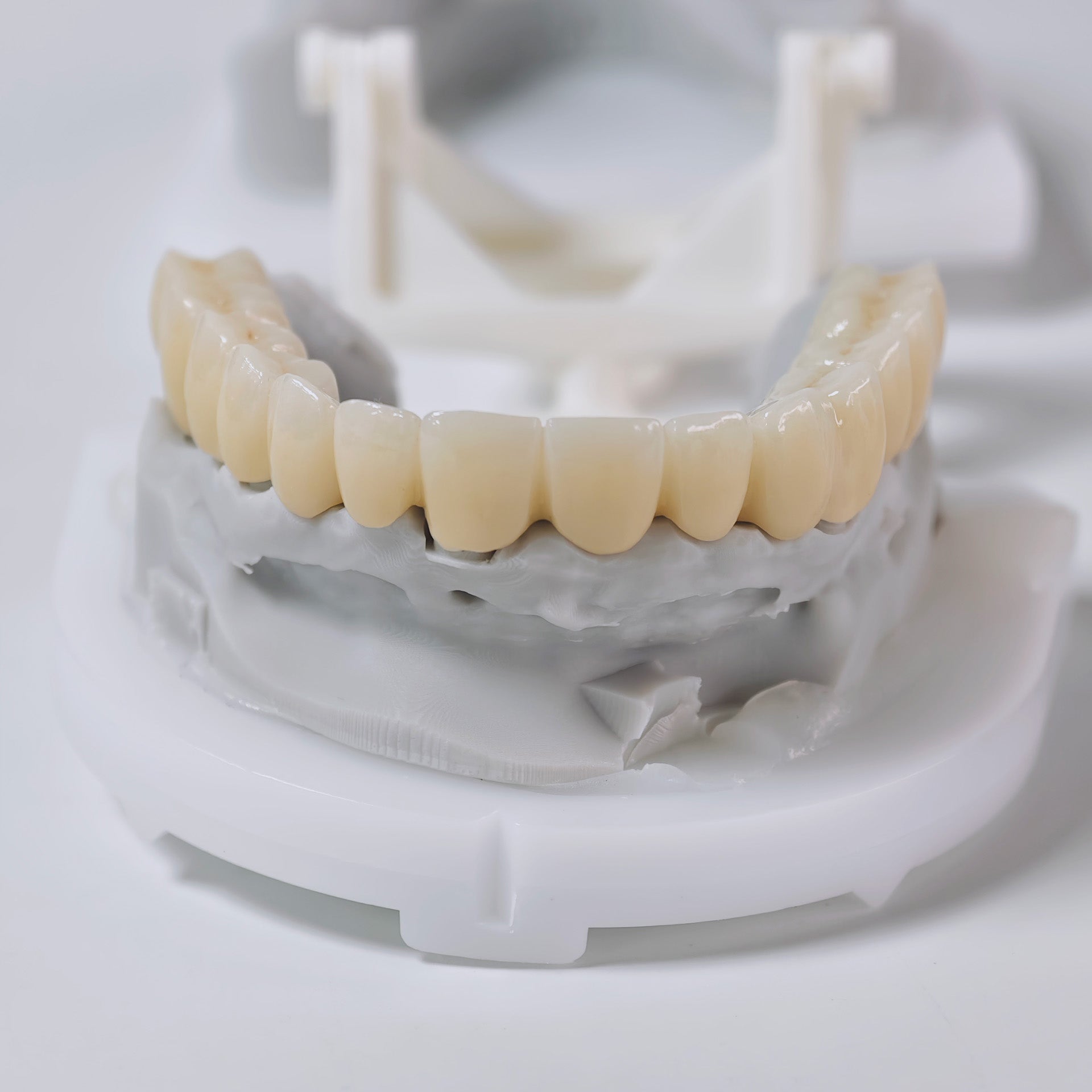 Ti-Bar Titanium Nitride Metal Frame With Zirconia Bridge And Cement Retained
