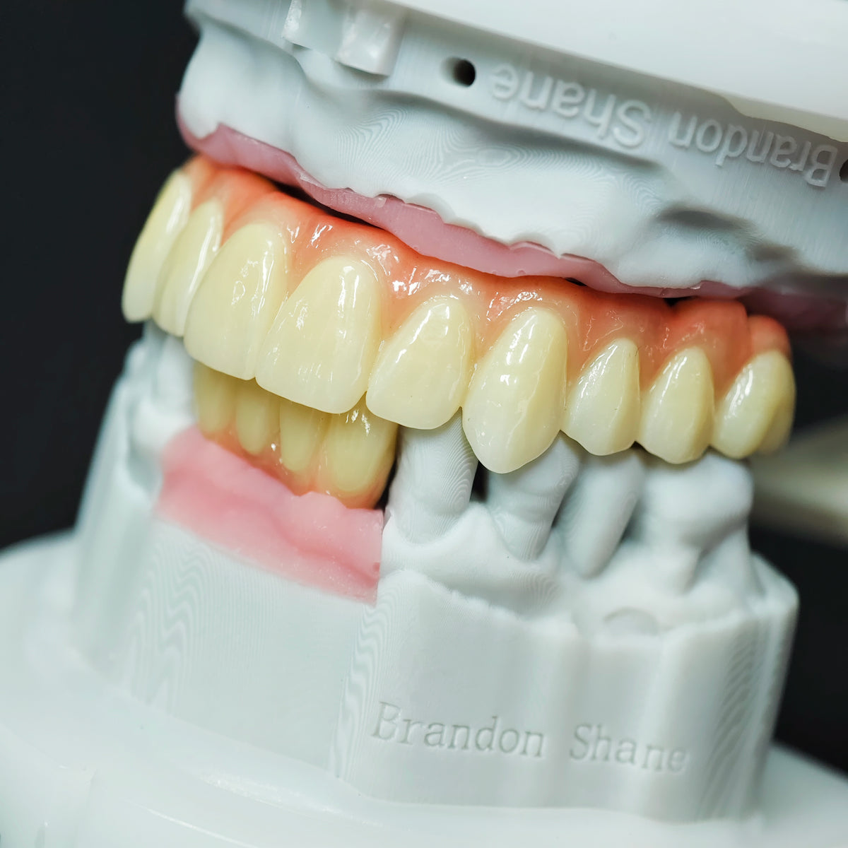 Ti-Bar Titanium Nitride Metal Frame With Zirconia Bridge For Full Arch Restoration