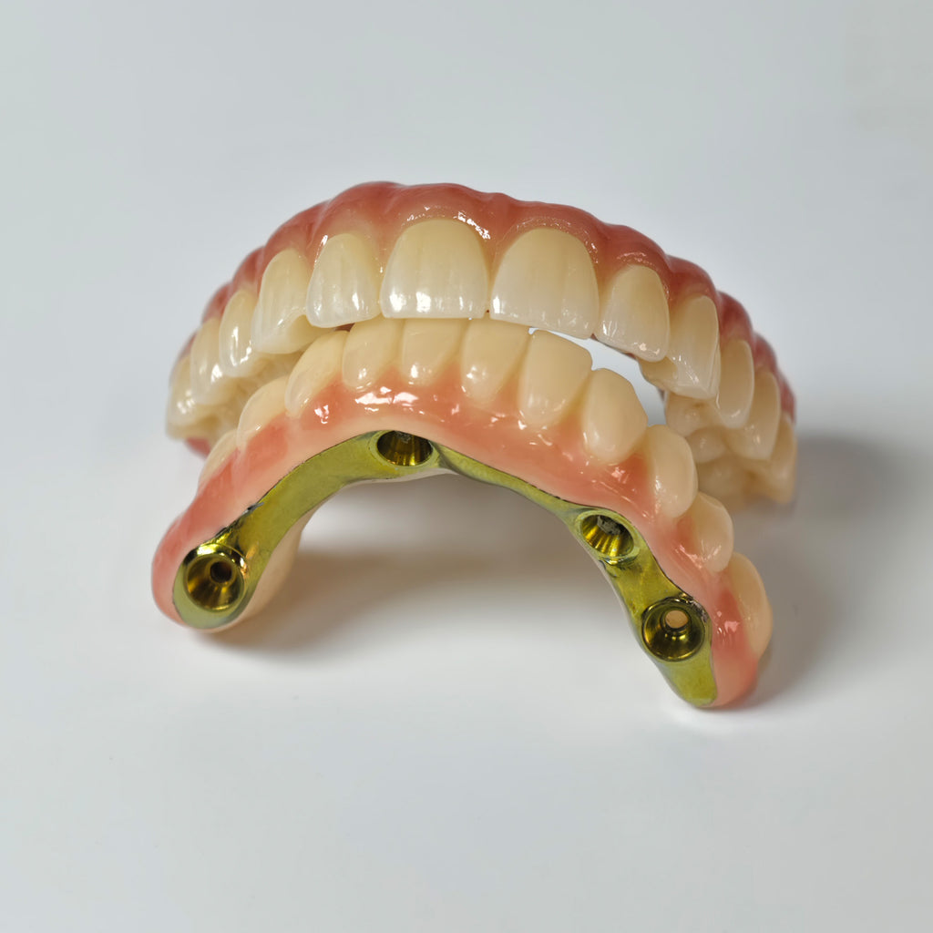 Ti-Bar Titanium Nitride Metal Frame With Zirconia Bridge For Full Arch Restoration
