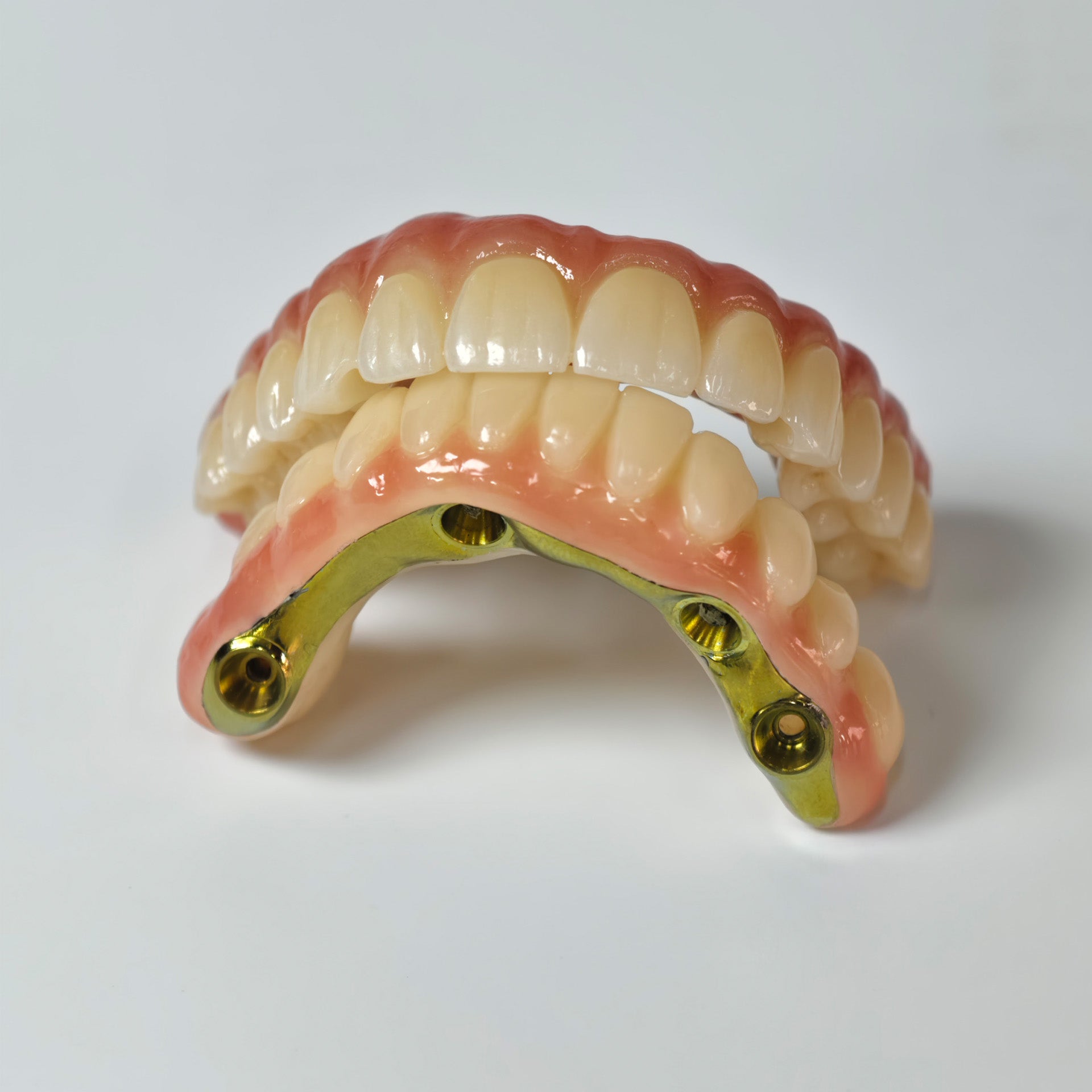 Ti-Bar Titanium Nitride Metal Frame With Zirconia Bridge For Full Arch Restoration
