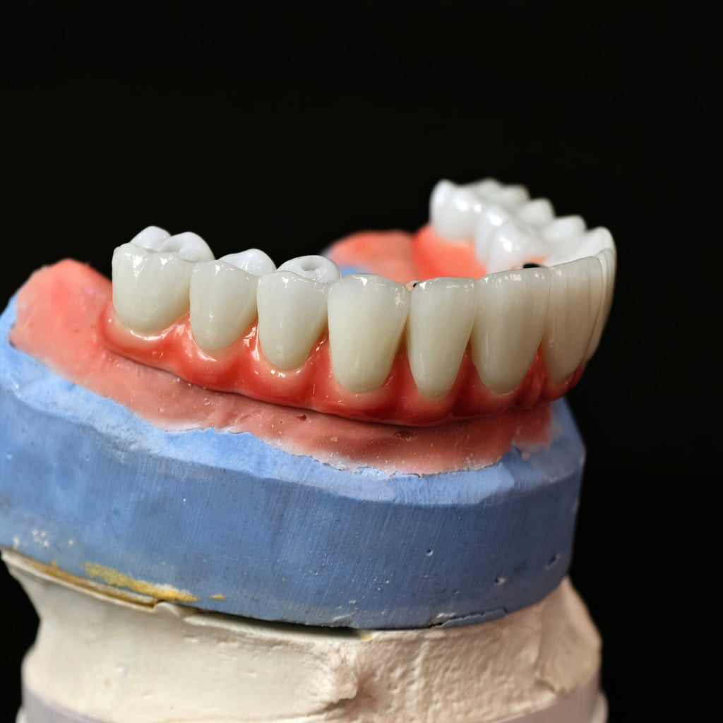 Traditional Malo Bridge With Alloy Framework Covering The Gingiva