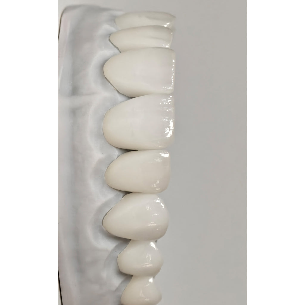Ultra-Thin Emax Veneer. High Transparency/Translucent, Natural Shade