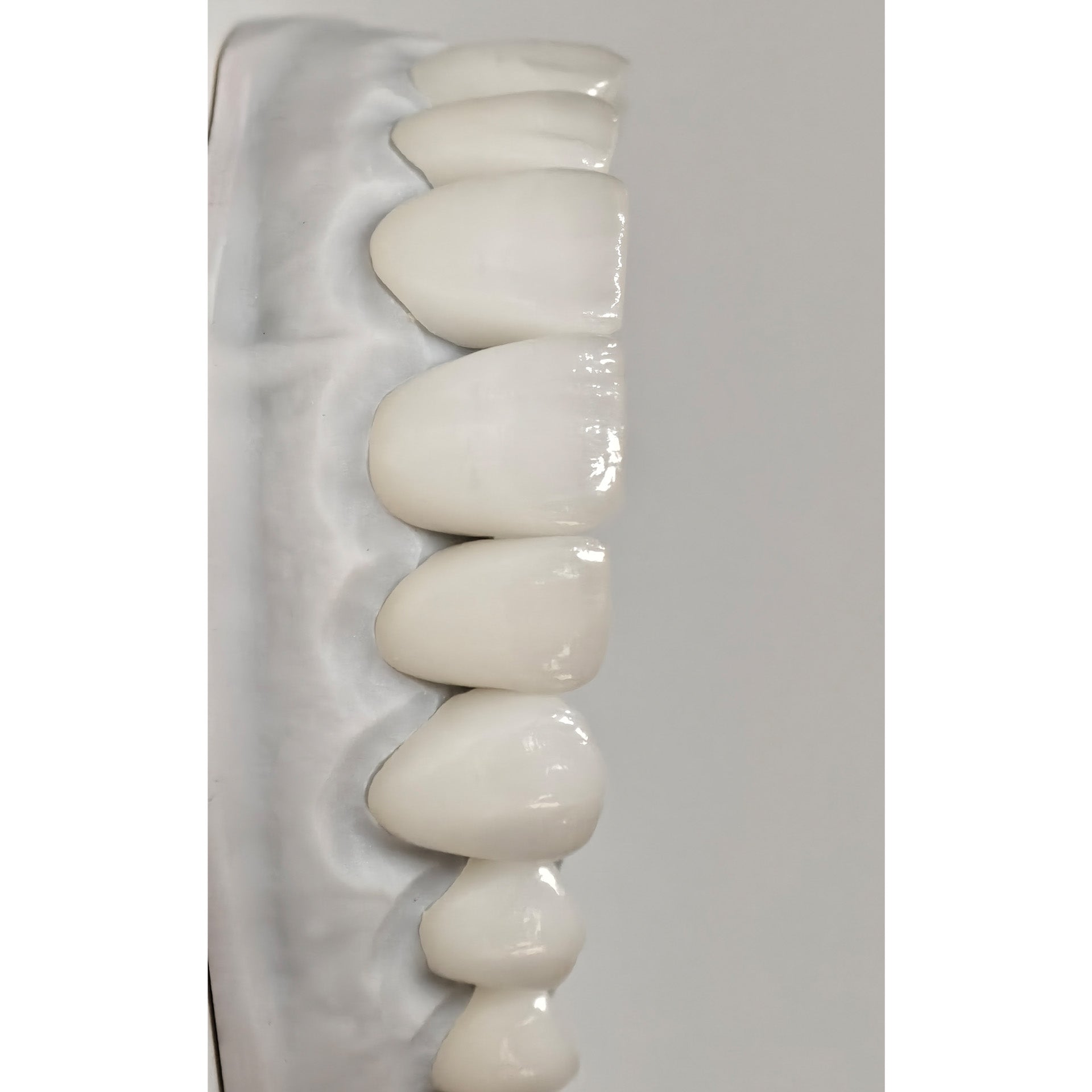 Ultra-Thin Emax Veneer. High Transparency/Translucent, Natural Shade