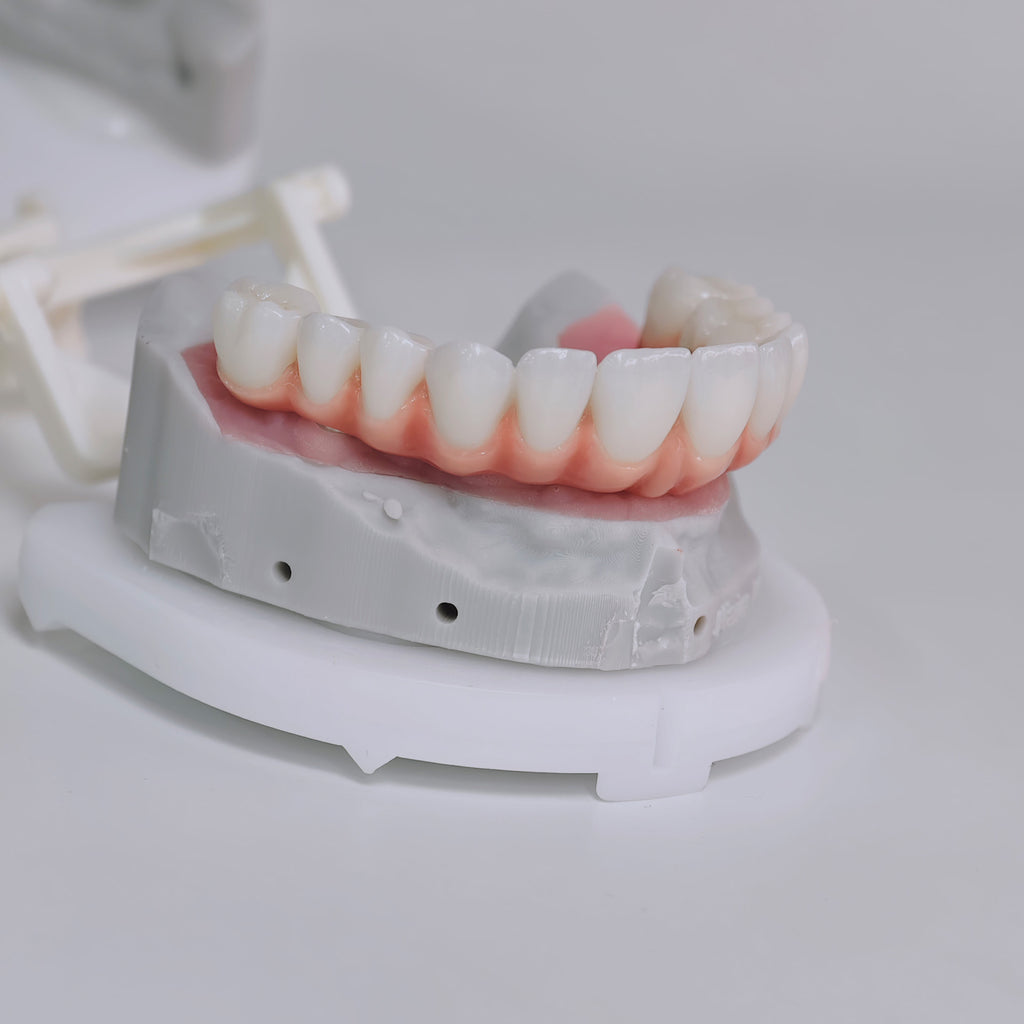 Zirconia-Enamel Hybrid Malo Bridge Aesthetic